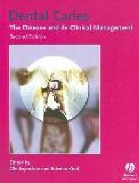Image of Dental caries the disease and its clinical management